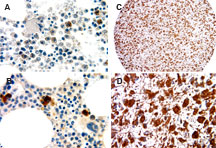 NALP1 / NLRP1 Antibody - Formalin-fixed, paraffin-embedded human tissue sections probed with NALP1 antibody at 1:2000. A, bone marrow. B, brain glioma core from a brain cancer microarray. A1 and B1 are higher magnifications of A and B, respectively. Hematoxylin-Eos in counterstain.
