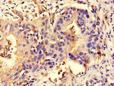 NALP3 / NLRP3 Antibody - Immunohistochemistry of paraffin-embedded human bladder cancer using NLRP3 Antibody at dilution of 1:100