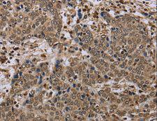 NALP4 / NLRP4 Antibody - Immunohistochemistry of paraffin-embedded Human prostate cancer using NLRP4 Polyclonal Antibody at dilution of 1:40.