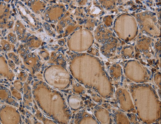 NALP4 / NLRP4 Antibody - Immunohistochemistry of paraffin-embedded Human prostate cancer using NLRP4 Polyclonal Antibody at dilution of 1:30.
