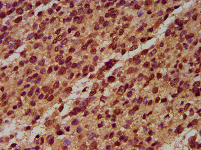 NALP6 / NLRP6 Antibody - Immunohistochemistry Dilution at 1:400 and staining in paraffin-embedded human glioma cancer performed on a Leica BondTM system. After dewaxing and hydration, antigen retrieval was mediated by high pressure in a citrate buffer (pH 6.0). Section was blocked with 10% normal Goat serum 30min at RT. Then primary antibody (1% BSA) was incubated at 4°C overnight. The primary is detected by a biotinylated Secondary antibody and visualized using an HRP conjugated SP system.