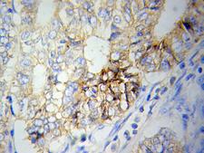 NAMPT / Visfatin Antibody - Immunohistochemistry (IHC) analysis of NAMPT pAb in paraffin-embedded Ovary cancer tissue.
