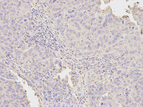 NAMPT / Visfatin Antibody - Immunohistochemistry of paraffin-embedded human liver cancer using NAMPT antibody at dilution of 1:200 (200x lens).