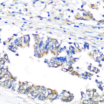 NAMPT / Visfatin Antibody - Immunohistochemistry of paraffin-embedded human colon carcinoma using NAMPT antibodyat dilution of 1:100 (40x lens).