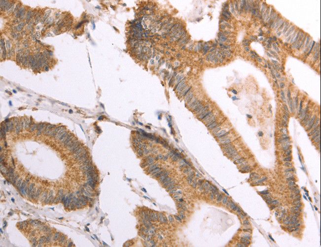 NAMPT / Visfatin Antibody - Immunohistochemistry of paraffin-embedded Human colon cancer using NAMPT Polyclonal Antibody at dilution of 1:30.