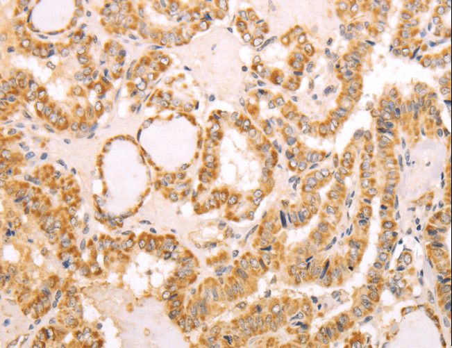 NAMPT / Visfatin Antibody - Immunohistochemistry of paraffin-embedded Human thyroid cancer using NAMPT Polyclonal Antibody at dilution of 1:30.