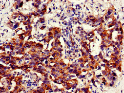 NAMPT / Visfatin Antibody - Immunohistochemistry of paraffin-embedded human bladder cancer at dilution of 1:100