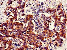 NAMPT / Visfatin Antibody - Immunohistochemistry of paraffin-embedded human bladder cancer at dilution of 1:100