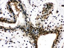NAMPT / Visfatin Antibody - IHC testing of FFPE human breast cancer tissue with Visfatin antibody at 1ug/ml. HIER: steam in pH6 citrate buffer and allow to cool prior to staining.