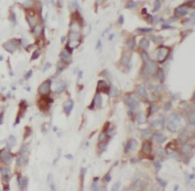 NAMPT / Visfatin Antibody - Immunohistochemistry of paraffin-embedded human breast cancer tissue slide using Visfatin antibody at dilution of 1:200