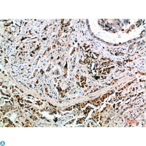NANOS1 / NOS1 Antibody - Immunohistochemical analysis of paraffin-embedded human-breast-cancer, antibody was diluted at 1:200.