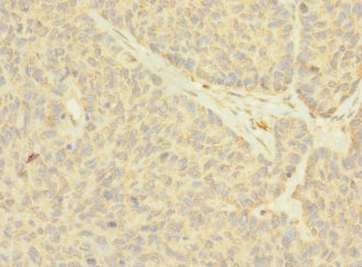 NANOS2 / NOS2 Antibody - Immunohistochemistry of paraffin-embedded human ovarian cancer using NANOS2 Antibody at dilution of 1:100