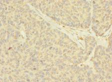 NANOS2 / NOS2 Antibody - Immunohistochemistry of paraffin-embedded human ovarian cancer using NANOS2 Antibody at dilution of 1:100