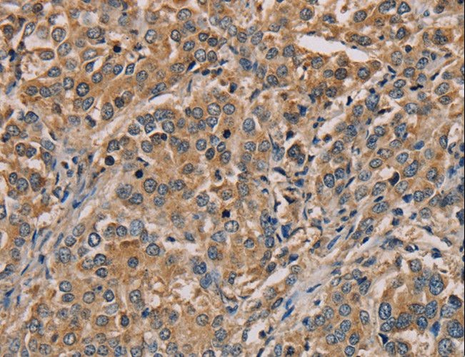NANOS2 / NOS2 Antibody - Immunohistochemistry of paraffin-embedded Human breast cancer using NANOS2 Polyclonal Antibody at dilution of 1:30.