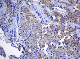 NANP Antibody - IHC of paraffin-embedded Carcinoma of Human thyroid tissue using anti-NANP mouse monoclonal antibody.