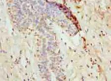 NANP Antibody - Immunohistochemistry of paraffin-embedded human breast cancer using antibody at dilution of 1:100.
