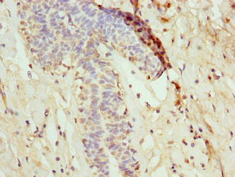 NANP Antibody - Immunohistochemistry of paraffin-embedded human breast cancer using NANP Antibody at dilution of 1:100