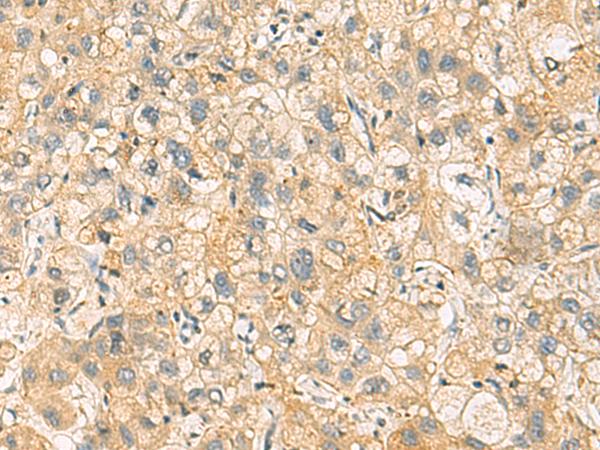 NANP Antibody - Immunohistochemistry of paraffin-embedded Human liver cancer tissue  using NANP Polyclonal Antibody at dilution of 1:65(×200)