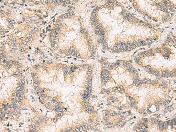 NANP Antibody - Immunohistochemistry of paraffin-embedded Human lung cancer tissue  using NANP Polyclonal Antibody at dilution of 1:65(×200)