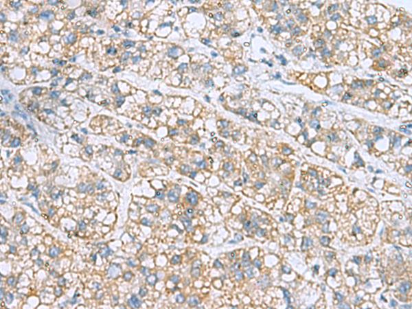 NANP Antibody - Immunohistochemistry of paraffin-embedded Human liver cancer tissue  using NANP Polyclonal Antibody at dilution of 1:50(×200)