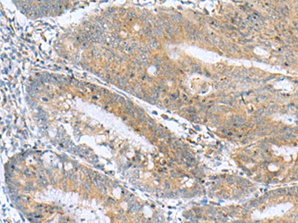 NANP Antibody - Immunohistochemistry of paraffin-embedded Human colorectal cancer tissue  using NANP Polyclonal Antibody at dilution of 1:50(×200)