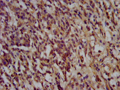 NANS Antibody - IHC image of NANS Antibody diluted at 1:200 and staining in paraffin-embedded human gastric cancer performed on a Leica BondTM system. After dewaxing and hydration, antigen retrieval was mediated by high pressure in a citrate buffer (pH 6.0). Section was blocked with 10% normal goat serum 30min at RT. Then primary antibody (1% BSA) was incubated at 4°C overnight. The primary is detected by a biotinylated secondary antibody and visualized using an HRP conjugated SP system.