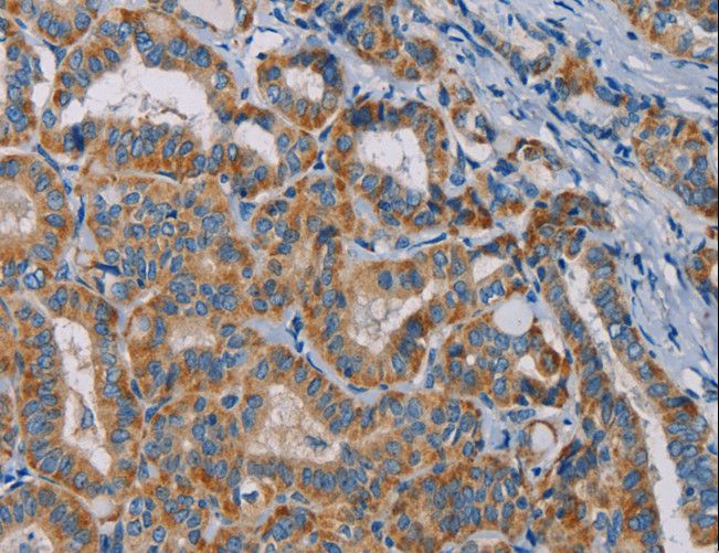 NAP1 / TAB3 Antibody - Immunohistochemistry of paraffin-embedded Human thyroid cancer using TAB3 Polyclonal Antibody at dilution of 1:25.