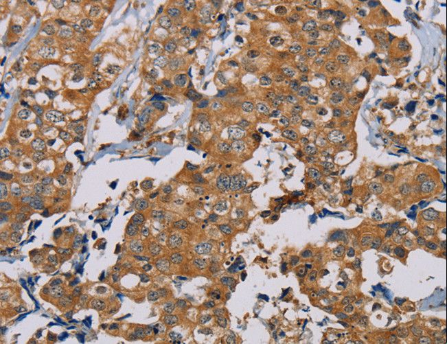 NAP1 / TAB3 Antibody - Immunohistochemistry of paraffin-embedded Human thyroid cancer using TAB3 Polyclonal Antibody at dilution of 1:35.