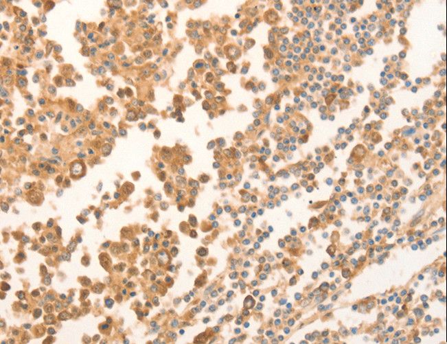 NAP1L1 Antibody - Immunohistochemistry of paraffin-embedded Human tonsil using NAP1L1 Polyclonal Antibody at dilution of 1:70.