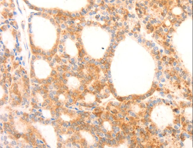 NAP1L1 Antibody - Immunohistochemistry of paraffin-embedded Human thyroid cancer using NAP1L1 Polyclonal Antibody at dilution of 1:70.