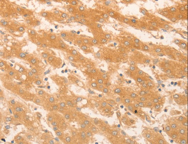 NAP1L1 Antibody - Immunohistochemistry of paraffin-embedded Human liver cancer using NAP1L1 Polyclonal Antibody at dilution of 1:50.