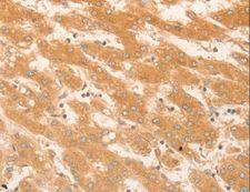 NAP1L1 Antibody - Immunohistochemistry of paraffin-embedded Human liver cancer using NAP1L1 Polyclonal Antibody at dilution of 1:50.