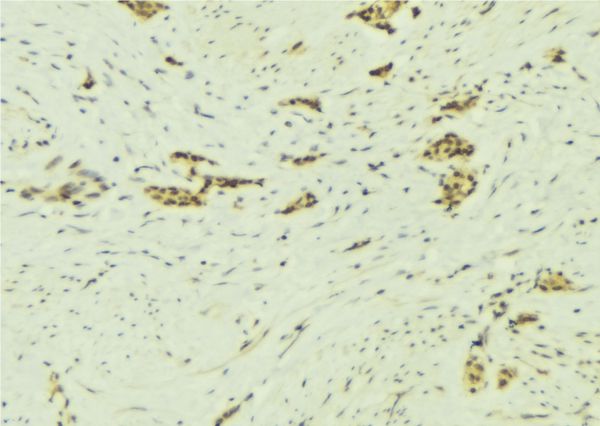 NAP1L1 Antibody - 1:100 staining human breast carcinoma tissue by IHC-P. The sample was formaldehyde fixed and a heat mediated antigen retrieval step in citrate buffer was performed. The sample was then blocked and incubated with the antibody for 1.5 hours at 22°C. An HRP conjugated goat anti-rabbit antibody was used as the secondary.