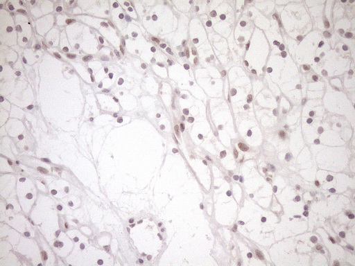 NAP1L3 Antibody - Immunohistochemical staining of paraffin-embedded Carcinoma of Human kidney tissue using anti-NAP1L3 mouse monoclonal antibody. (Heat-induced epitope retrieval by 1mM EDTA in 10mM Tris buffer. (pH8.5) at 120°C for 3 min. (1:150)