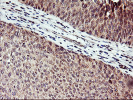 NAPE-PLD Antibody - Immunohistochemical staining of paraffin-embedded Carcinoma of Human bladder tissue using anti-NAPEPLD mouse monoclonal antibody. (Heat-induced epitope retrieval by 10mM citric buffer, pH6.0, 100C for 10min,