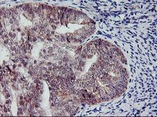 NAPE-PLD Antibody - Immunohistochemical staining of paraffin-embedded Adenocarcinoma of Human endometrium tissue using anti-NAPEPLD mouse monoclonal antibody. (Heat-induced epitope retrieval by 10mM citric buffer, pH6.0, 100C for 10min,