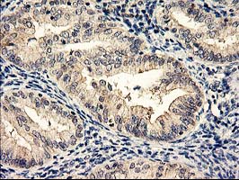 NAPE-PLD Antibody - IHC of paraffin-embedded Adenocarcinoma of Human endometrium tissue using anti-NAPEPLD mouse monoclonal antibody.