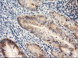 NAPE-PLD Antibody - IHC of paraffin-embedded Adenocarcinoma of Human endometrium tissue using anti-NAPEPLD mouse monoclonal antibody.