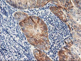 NAPE-PLD Antibody - IHC of paraffin-embedded Adenocarcinoma of Human endometrium tissue using anti-NAPEPLD mouse monoclonal antibody.