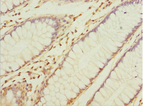 NAPG Antibody - Immunohistochemistry of paraffin-embedded human colon cancer at dilution 1:100