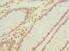 NAPG Antibody - Immunohistochemistry of paraffin-embedded human colon cancer at dilution 1:100