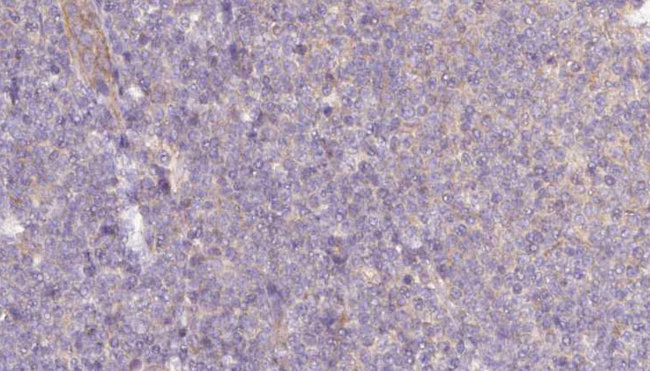 NAPRT Antibody - 1:100 staining human lymph carcinoma tissue by IHC-P. The sample was formaldehyde fixed and a heat mediated antigen retrieval step in citrate buffer was performed. The sample was then blocked and incubated with the antibody for 1.5 hours at 22°C. An HRP conjugated goat anti-rabbit antibody was used as the secondary.