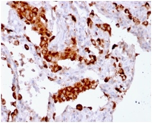NAPSA / NAPA / Napsin A Antibody - Formalin-fixed, paraffin-embedded human Lung Adenocarcinoma stained with NapsinA Mouse Recombinant Monoclonal Antibody (rNAPSA/1239).