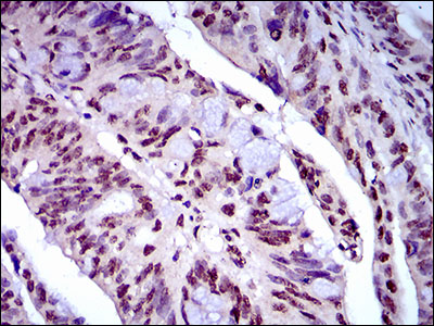 NAPSA / NAPA / Napsin A Antibody - IHC of paraffin-embedded rectum cancer tissues using NAPSA mouse monoclonal antibody with DAB staining.