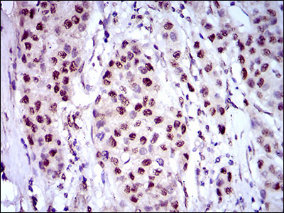 NAPSA / NAPA / Napsin A Antibody - IHC of paraffin-embedded liver cancer tissues using NAPSA mouse monoclonal antibody with DAB staining.