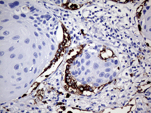 NAPSA / NAPA / Napsin A Antibody - Immunohistochemical staining of paraffin-embedded Carcinoma of Human lung tissue using anti-NAPSA mouse monoclonal antibody. (Heat-induced epitope retrieval by 1mM EDTA in 10mM Tris buffer. (pH8.0) at 120°C for 3 min. (1:400)