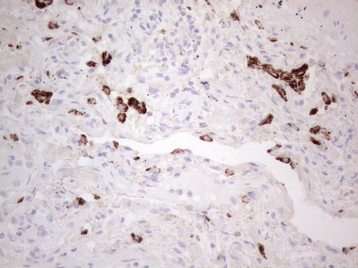 NAPSA / NAPA / Napsin A Antibody - Immunohistochemical staining of paraffin-embedded Carcinoma of Human lung tissue using anti-NAPSA mouse monoclonal antibody. (Heat-induced epitope retrieval by 1mM EDTA in 10mM Tris buffer. (pH8.5) at 110°C for 10 min. (1:150)