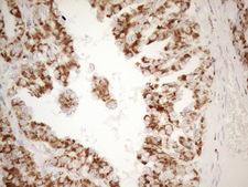 NAPSA / NAPA / Napsin A Antibody - Immunohistochemical staining of paraffin-embedded Carcinoma of Human thyroid tissue using anti-NAPSA mouse monoclonal antibody. (Heat-induced epitope retrieval by 1mM EDTA in 10mM Tris buffer. (pH8.5) at 120°C for 3 min. (1:150)