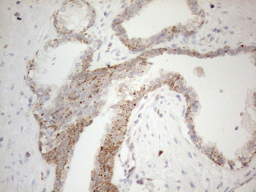 NAPSA / NAPA / Napsin A Antibody - Immunohistochemical staining of paraffin-embedded Carcinoma of Human prostate tissue using anti-NAPSA mouse monoclonal antibody. (Heat-induced epitope retrieval by 1mM EDTA in 10mM Tris buffer. (pH8.5) at 120°C for 3 min. (1:150)