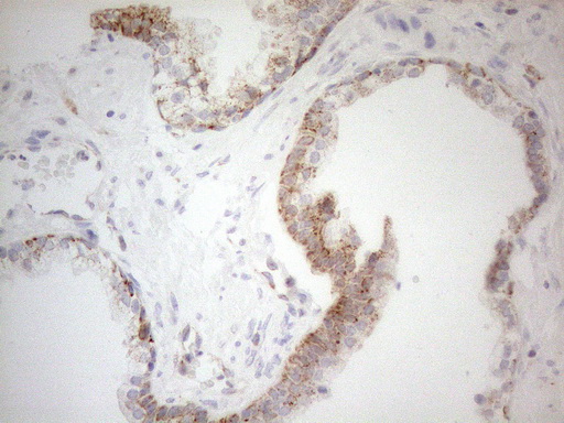 NAPSA / NAPA / Napsin A Antibody - Immunohistochemical staining of paraffin-embedded Carcinoma of Human prostate tissue using anti-NAPSA mouse monoclonal antibody. (Heat-induced epitope retrieval by 1mM EDTA in 10mM Tris buffer. (pH8.5) at 120°C for 3 min. (1:150)